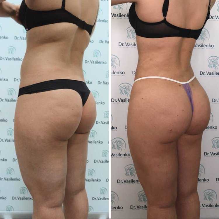 Липофилинг ягодиц асимметрия